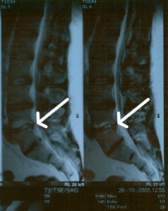 Desaparicion de la hernia discal L5 S1 despues de las infiltraciones paravertebrales de Ozono g