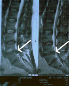 Hernia discal L5 S1 antes del tratamiento con infiltraciones paravertebrales de Ozono g