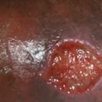 Ulcera varicosa 1 g