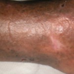 ulcera varicosa 2 g